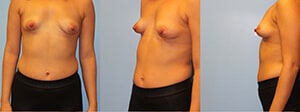 Correction of Tubular Breasts Before and After Pictures Case 974